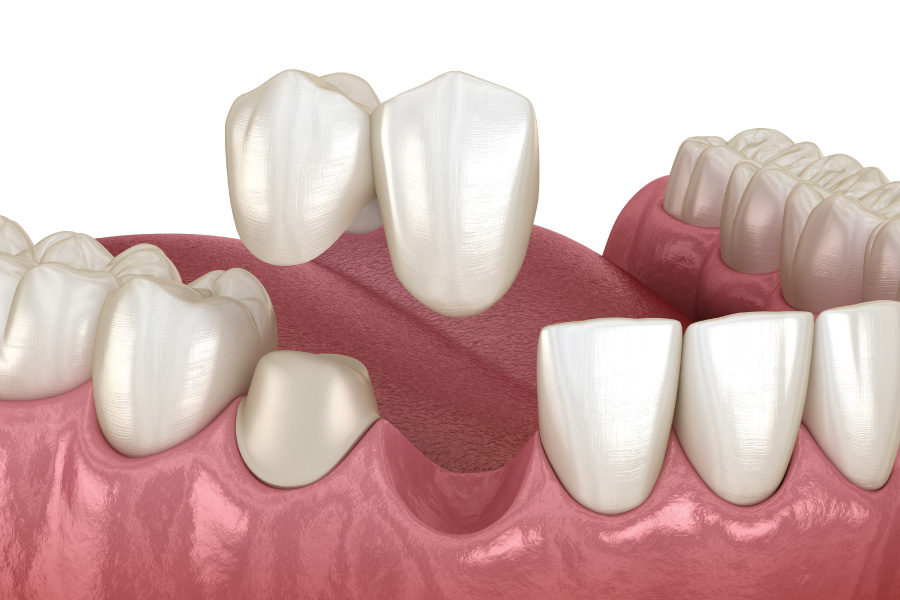 Arlington Cantilever Bridges