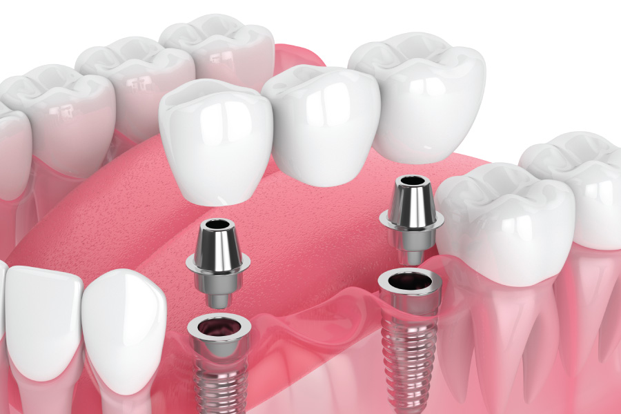 Arlington Implant-Supported Bridges