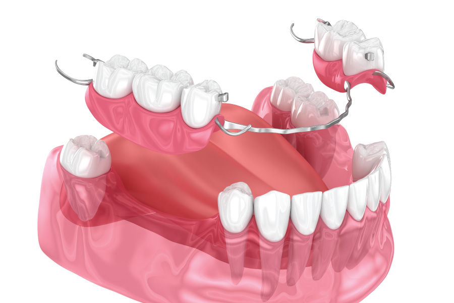 Arlington Partial Dentures