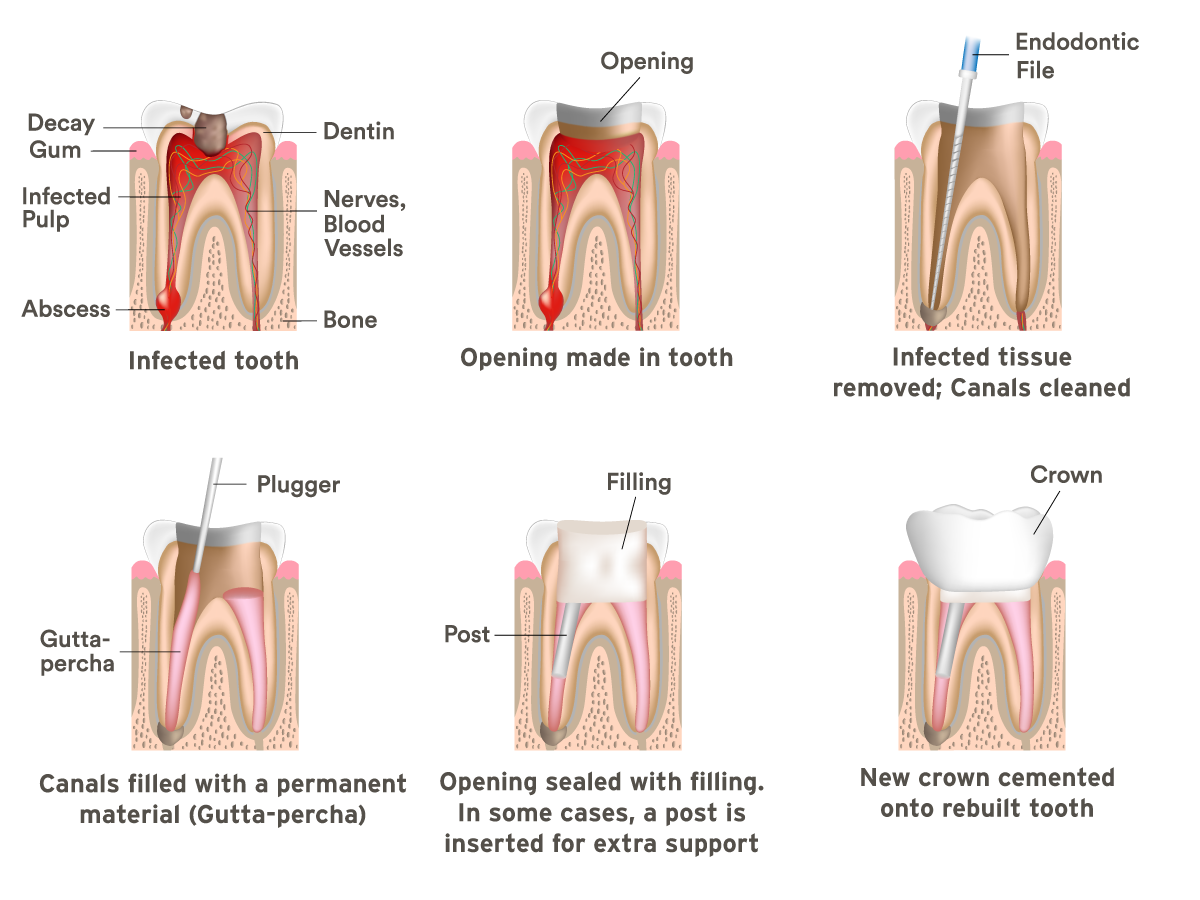 Arlington Root Canals