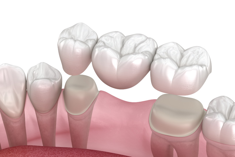 Arlington Traditional Bridges